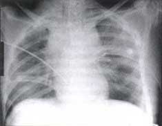 Rx control luego de colocar los tubos de toracostomía. Rx control luego de colocar los tubos de toracostomía.