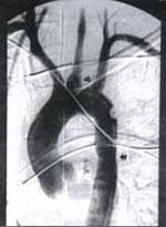 Arteriografía aórtica Sustracción Digital Arteriografía aórtica Sustracción Digital