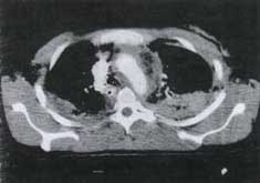 TAC helicoidal con contraste con trauma cerrado del tórax y desgarro aórtico TAC helicoidal con contraste con trauma cerrado del tórax y desgarro aórtico