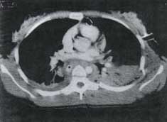 TAC helicoidal con contraste hematoma periaórtica y mediastinal TAC helicoidal con contraste hematoma periaórtica y mediastinal