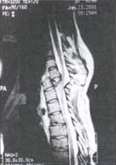 Resonancia magnética de columna torácica Resonancia magnética de columna torácica