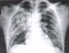 Radiografía AP con trauma cerrado del tórax Radiografía AP con trauma cerrado del tórax