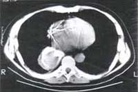 Desgarro esofágico traumático Desgarro esofágico traumático