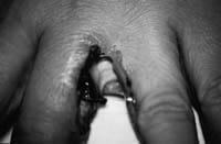 Lesión ulcerada con secreción purulenta Lesión ulcerada con secreción purulenta