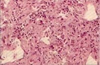 Estudio histológico de masa con neoplasia constituída por células histiocitoides Estudio histológico de masa con neoplasia constituída por células histiocitoides