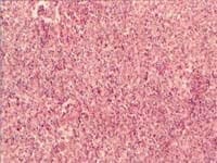 Estudio histológico de masa con neoplasia constituída por células histiocitoides Estudio histológico de masa con neoplasia constituída por células histiocitoides