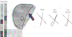 Pletismografía de sujeto con obstrucción