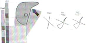 Plestismografía de sujeto con enfisema