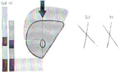 Pletismografía de un sujeto con patología restrictiva