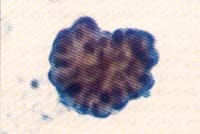 Lavado Broncoalveolar de paciente con Ca. Bronquioloalveolar. Lavado Broncoalveolar de paciente con Ca. Bronquioloalveolar.
