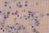 Lavado Broncoalveolar de paciente con Neumonía Eosinofílica Crónica Lavado Broncoalveolar de paciente con Neumonía Eosinofílica Crónica
