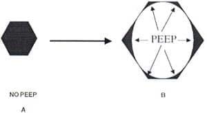 Representación esquemática del efecto de la PEEP Representación esquemática del efecto de la PEEP