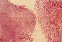 Biopsia Transbronquial de paciente con TBC Pulmonar Biopsia Transbronquial de paciente con TBC Pulmonar