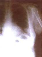 Rx tórax proyección lateral inicial.