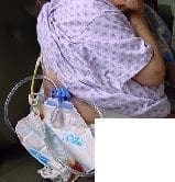 Paciente con drenaje ambulatorio Paciente con drenaje ambulatorio