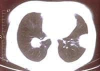 Fig 4A y B TAC tórax a nivel del segmento lateral basal del LII