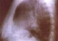 Rx tórax proyección P-A inicial