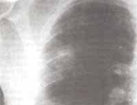 Acercamiento de imagen con opacidad cavitada