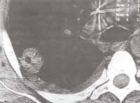 Escanografía torácica con imagen cavitaria de paredes gruesas