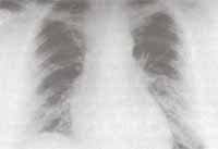 Rx. tórax simple imagen sugestiva de edema pulmonar.