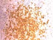 Biopsia transbronquial