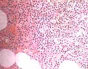 Biopsia de médula ósea con infiltrado linfoplasmocítico monoclonal