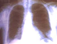 Biopsia de médula ósea con infiltrado linfoplasmocítico monoclonal