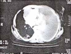 TAC de tórax con quiste pericárdico