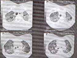 TAC de tórax TAC de tórax