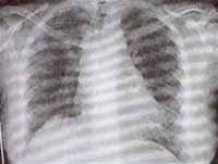 Rx tórax control Rx tórax control