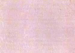 Areas con necrosis geográfica y presencia de numerosos canales vasculares.