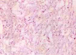 Acercamiento donde se observan células pleomórficas