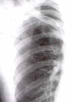 Neumotórax Espontáneo Neumotórax Espontáneo