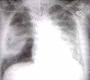 Neumotórax iatrogénico por catéter subclavio derecho