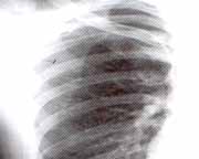 Neumotórax a tensión izquierdo.  Neumotórax a tensión izquierdo.