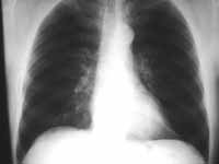 Oligohemia relativa por radiografía sobreexpuesta.