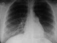 TEP. Vasos pequeños en pulmón izquierdo