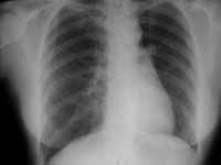 Pulmón hiperlucente unilateral (Swyer-James).