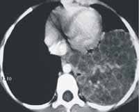 Tomografía computarizada de alta resolución