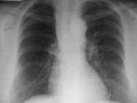 Atelectasia LSD. Hiperlucencia LM y LID.