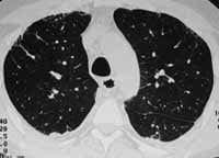 Enfisema centroacinar.