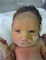 Paciente una micrognatia como única malformación craneofacial Paciente una micrognatia como única malformación craneofacial