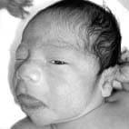 Fenotipo característico, donde se evidencia macroglosia y nevus flameus