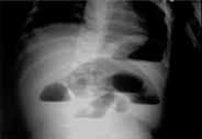 Radiografía de abdomen con niveles hidroaéreos Radiografía de abdomen con niveles hidroaéreos