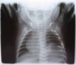 Placa Radiográfica Placa Radiográfica