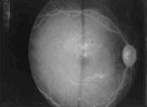 Lipemia Retinalis7 Lipemia Retinalis7