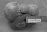 ista macroscópica de la pieza quirúrgica ista macroscópica de la pieza quirúrgica