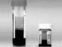 Suero lipémico por quilomicronemia severa. Suero lipémico por quilomicronemia severa.