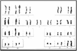 Traslocación Robertsoniana entre el cromosoma Traslocación Robertsoniana entre el cromosoma