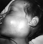 Adenopatía cervical viral por parotiditis Adenopatía cervical viral por parotiditis